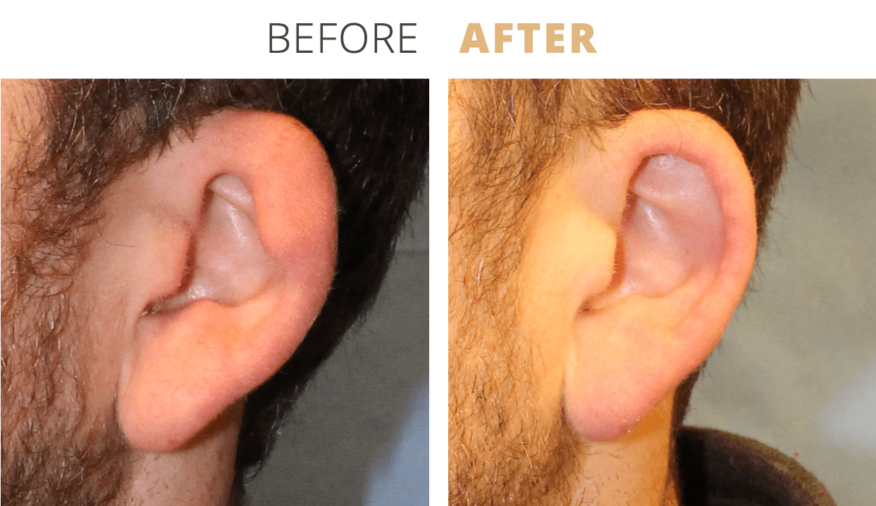 Face-EarSurgeryOtoplasty7