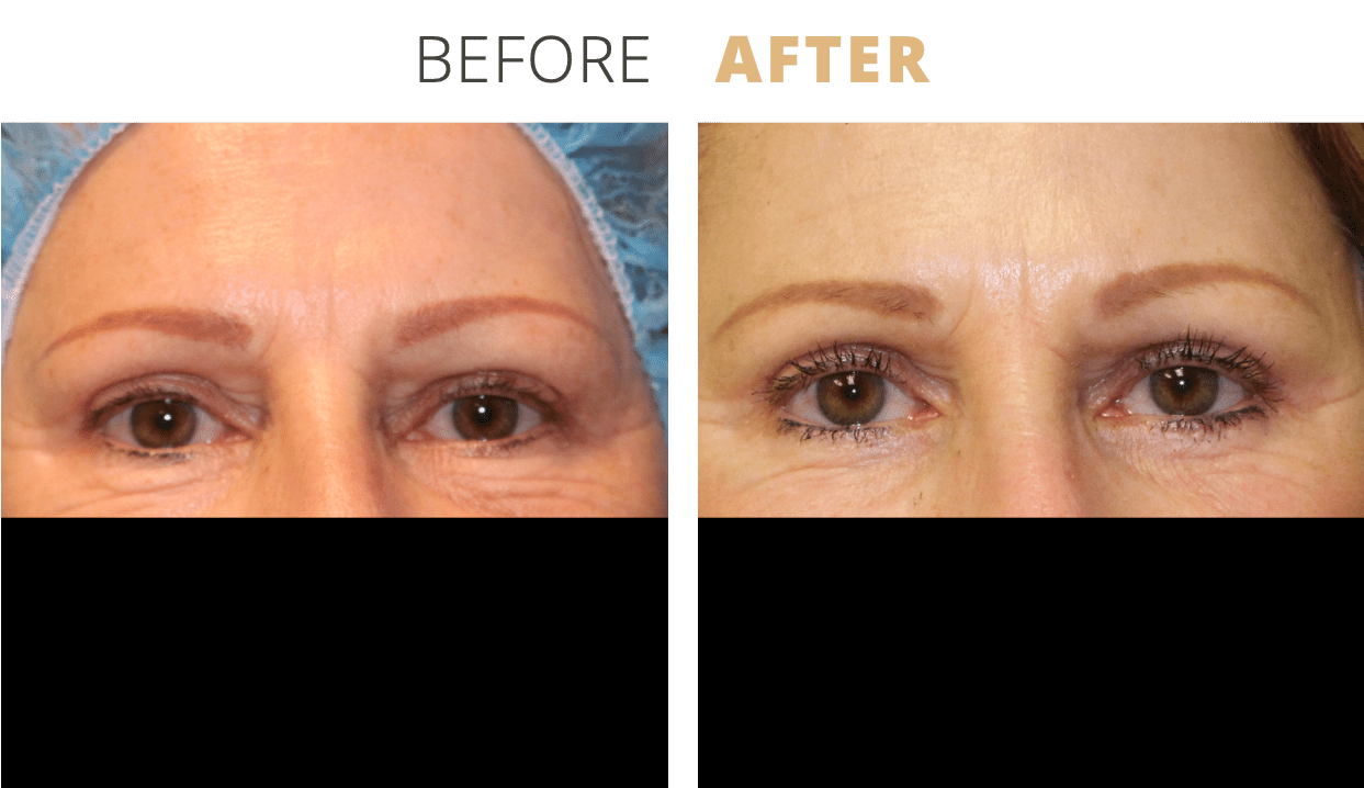 Face-EyelidSurgeryBlepharoplasty1