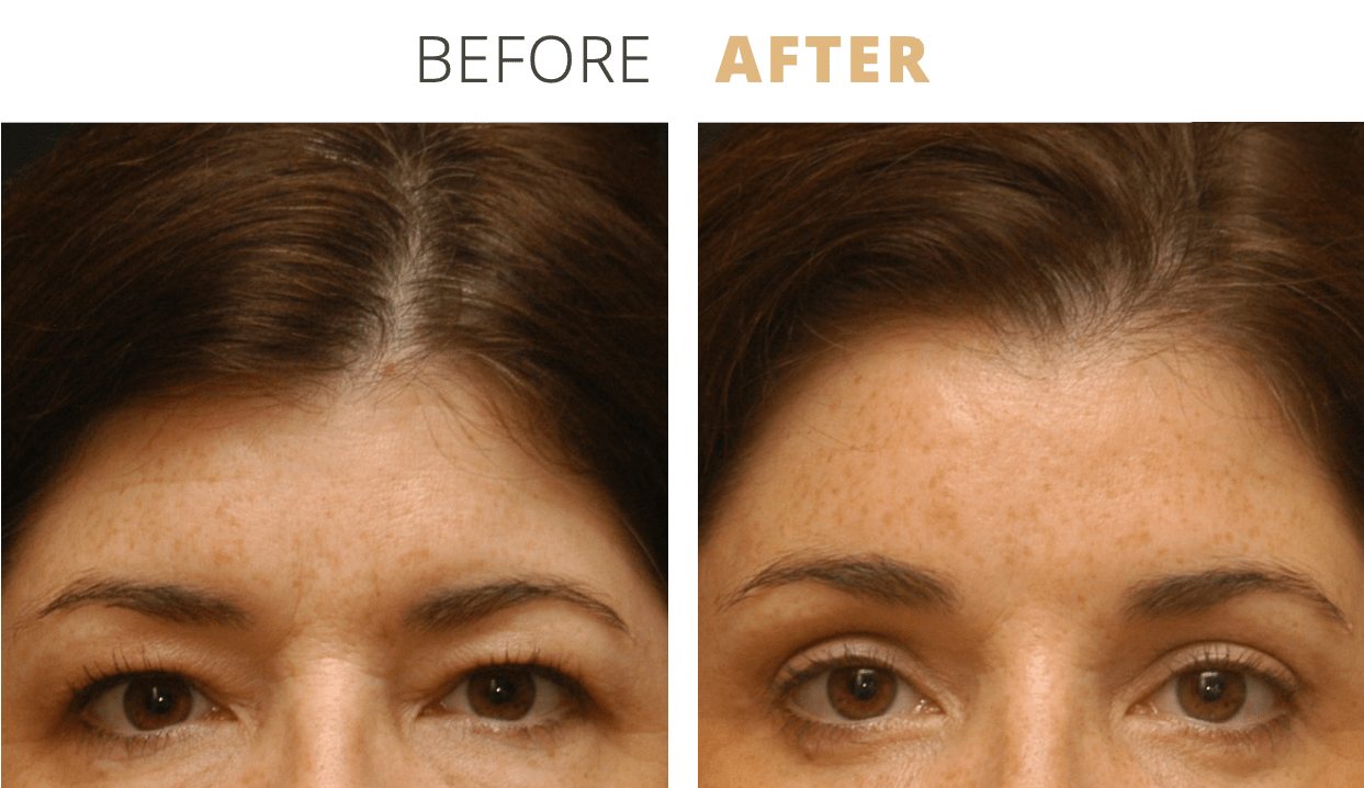 Face-EyelidSurgeryBlepharoplasty10