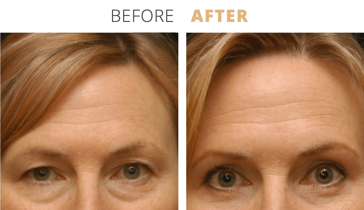Face-EyelidSurgeryBlepharoplasty11