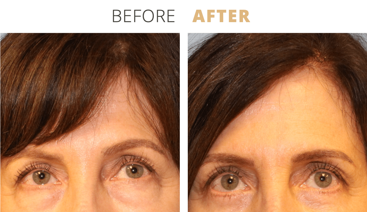 Face-EyelidSurgeryBlepharoplasty3
