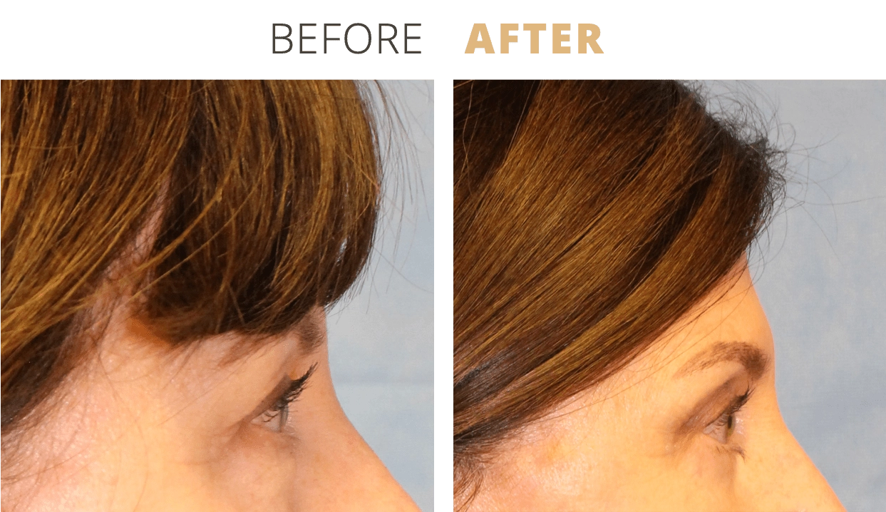 Face-EyelidSurgeryBlepharoplasty4