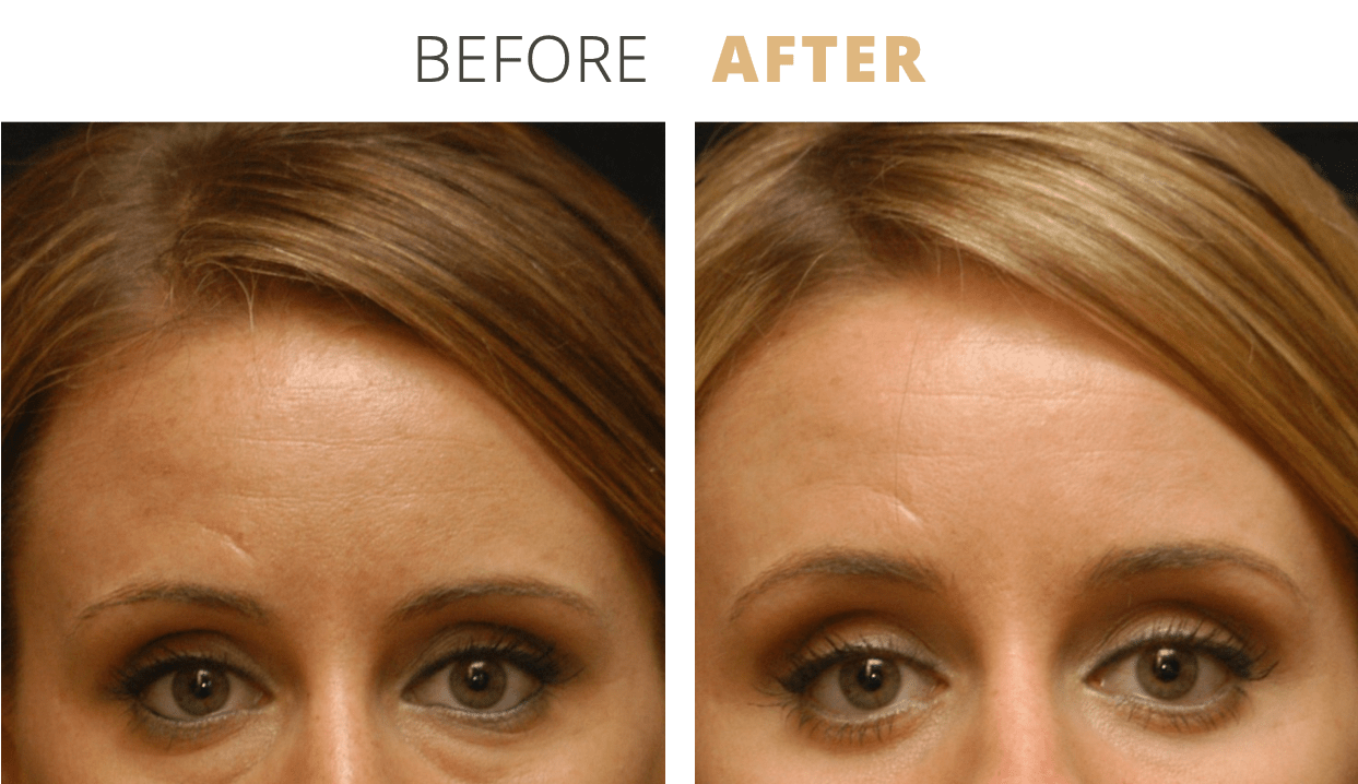 Face-EyelidSurgeryBlepharoplasty6