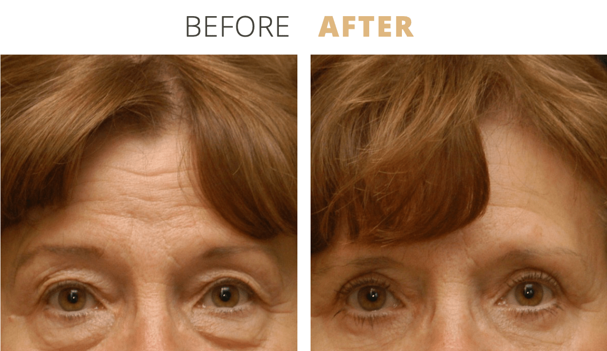 Face-EyelidSurgeryBlepharoplasty7