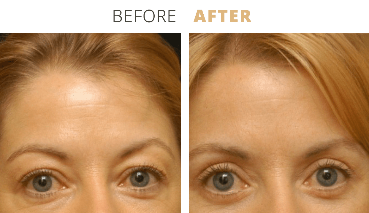 Face-EyelidSurgeryBlepharoplasty8