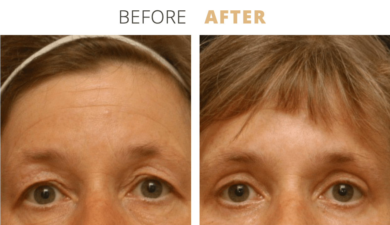 Face-EyelidSurgeryBlepharoplasty9