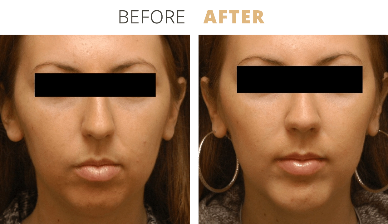 Face-NoseSurgeryRhinoplasty7