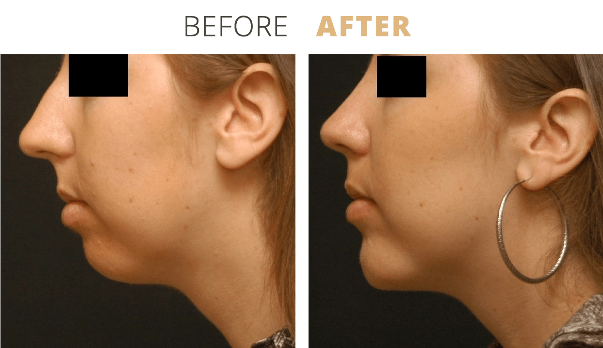 Face-NoseSurgeryRhinoplasty8