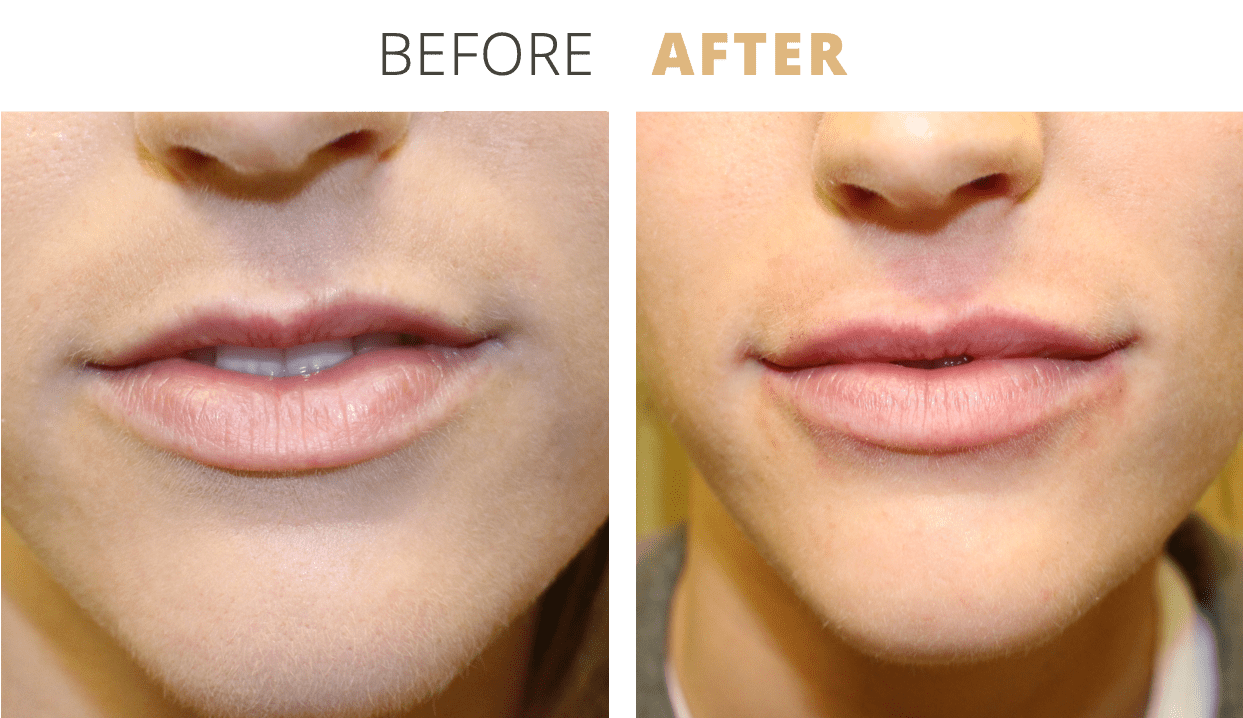 Injectables-LipFiller2