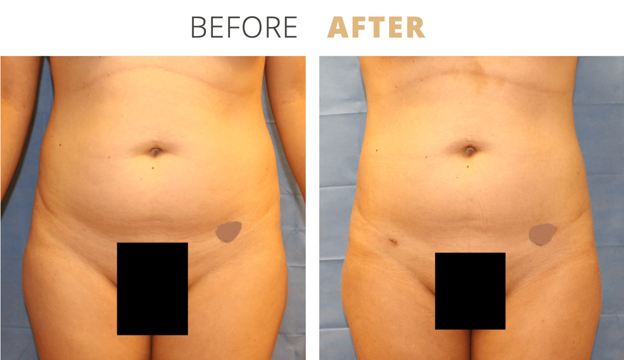 Body-Liposuction1
