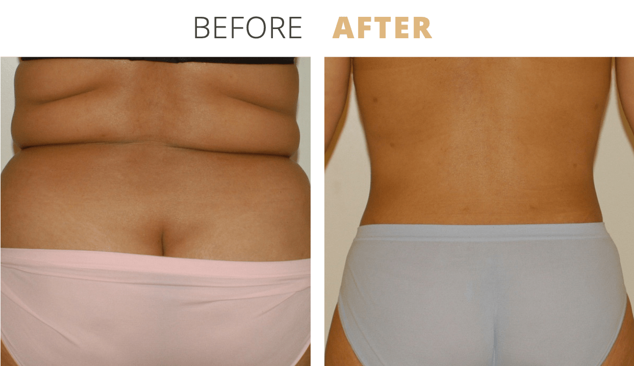 Body-Liposuction3