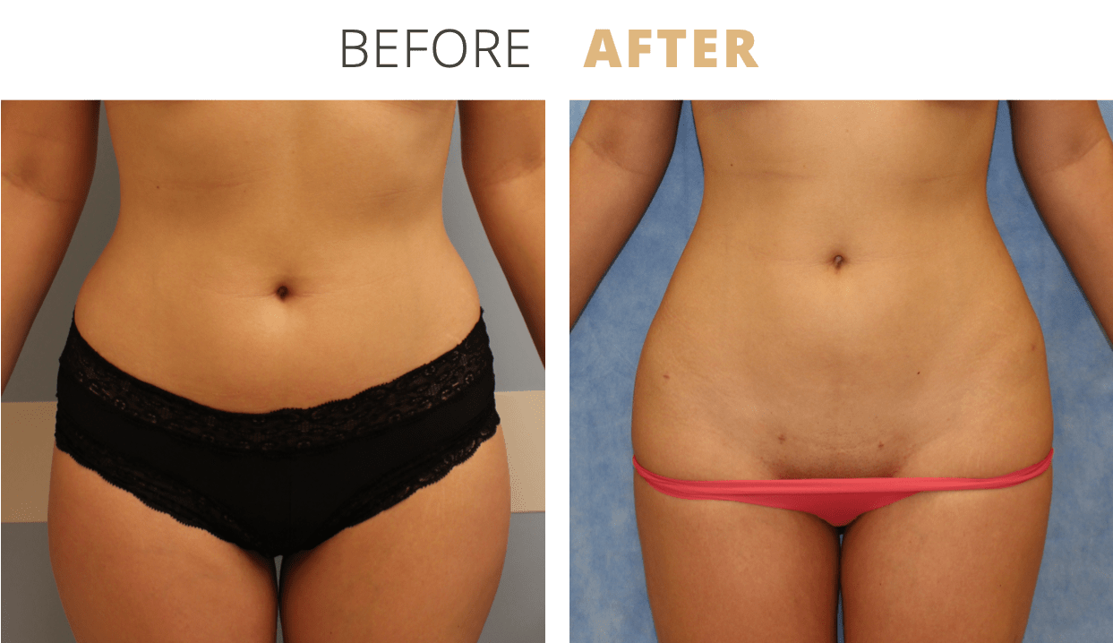 Body-Liposuction4