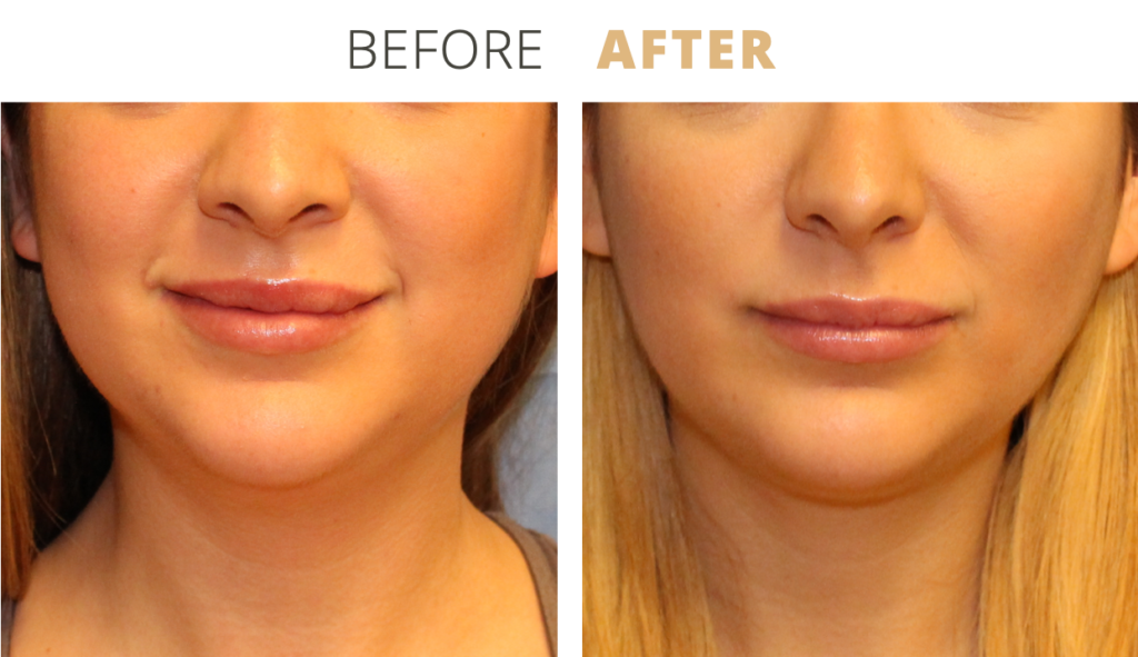 Face-Necklift9-1024x591 (1)