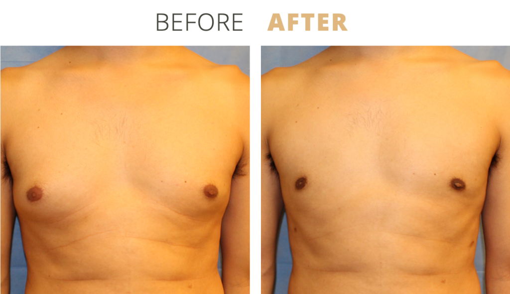 ForMen-MaleBreastReduction1-1024x591