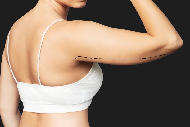 Arm Lift in Walnut Creek