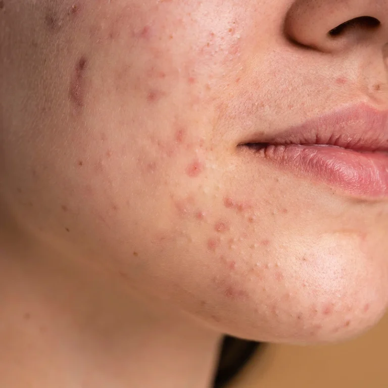 Congestion-Acne-768x768